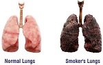 Smoking on Lung Health3 1