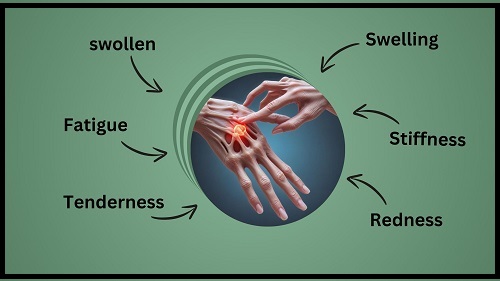 early rheumatoid arthritis