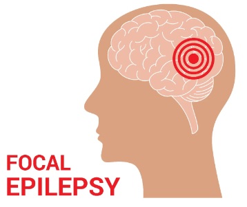 Focal-Onset Seizures