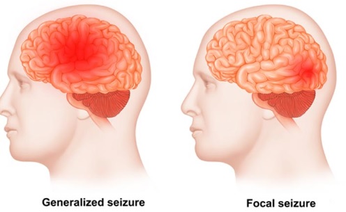 Generalized focal