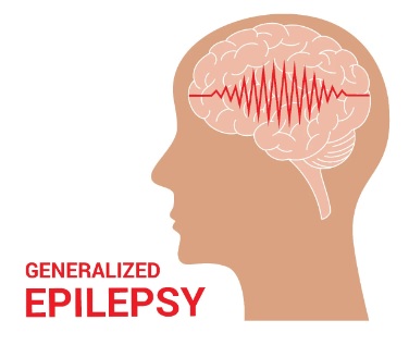 Generalized onset seizures