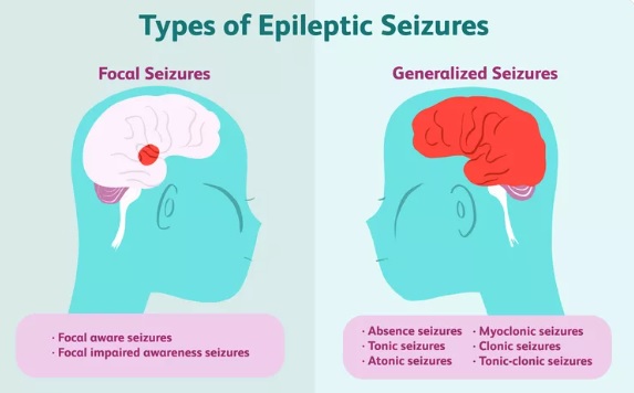 Types of Epilepsy 2