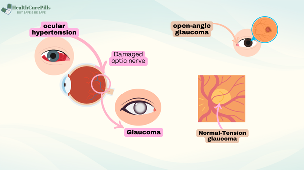 Lumigan 0.01% (Bimatoprost) Eye Drops 1 Lumigan 0.01% eye drops for glaucoma and ocular hypertension.